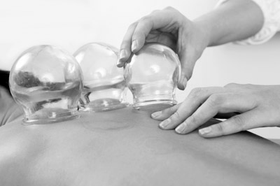 acupuncture technique of cupping