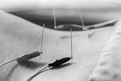 using electro acupuncture to increase the efficiency of acupuncture 